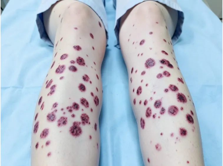 Vasculite gambe