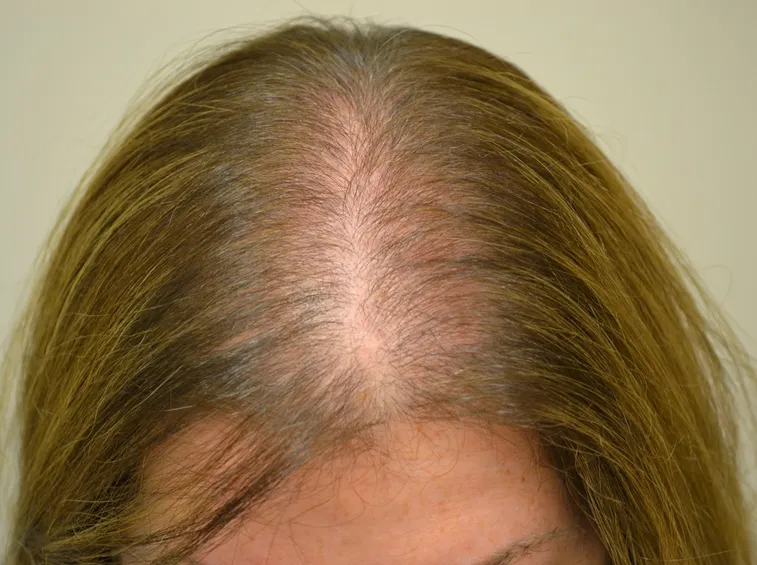 Caduta di capelli femminile