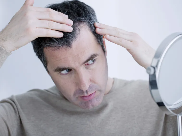 Inizio dell'alopecia androgenetica