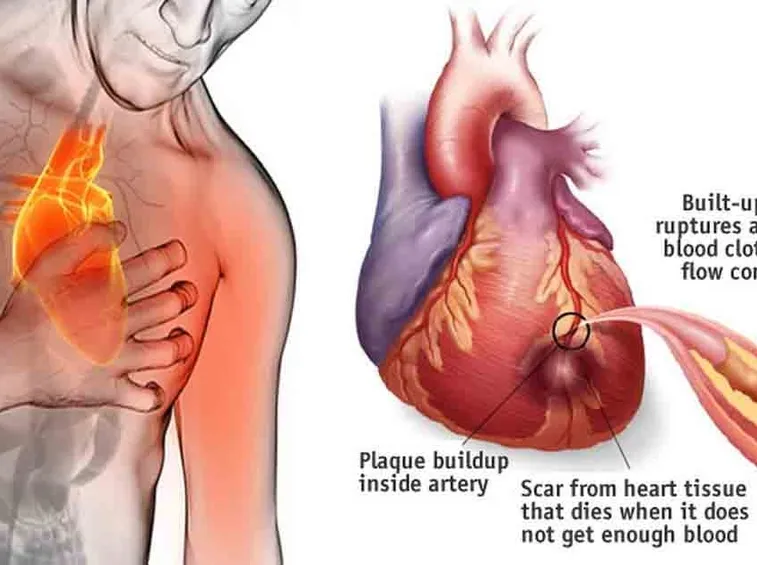 Infarto del miocardio