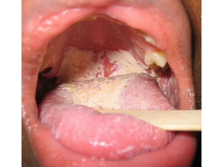 La formazione di una patina bianca sulla bocca è un sintomo di candida orale