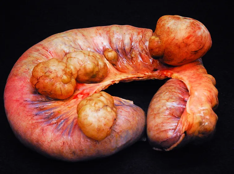Intestino con grossi diverticoli