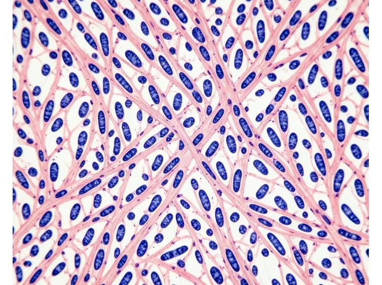 cellule fibroma ovarico
