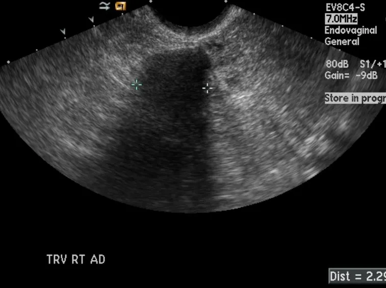 Ecografia di un fibroma dell'ovaio
