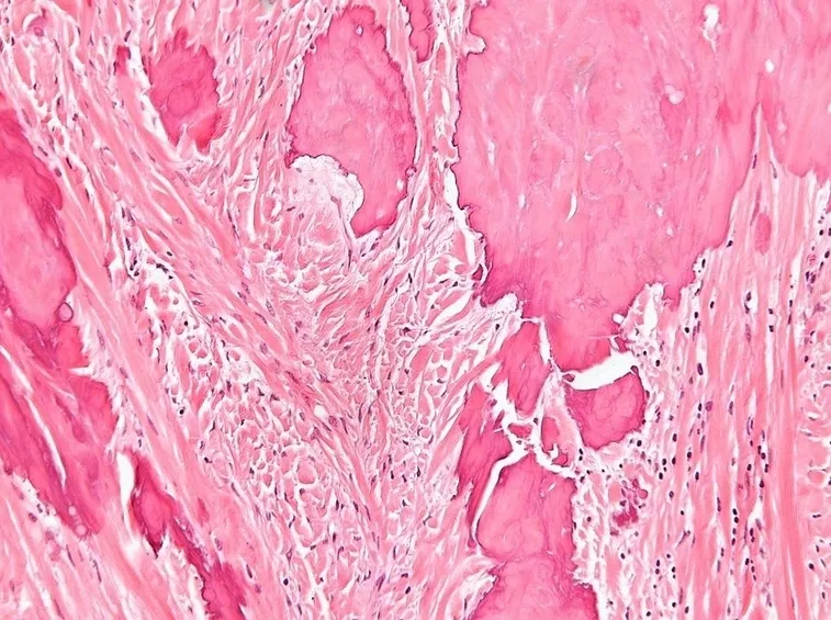 Fibroma ovarico al microscopio
