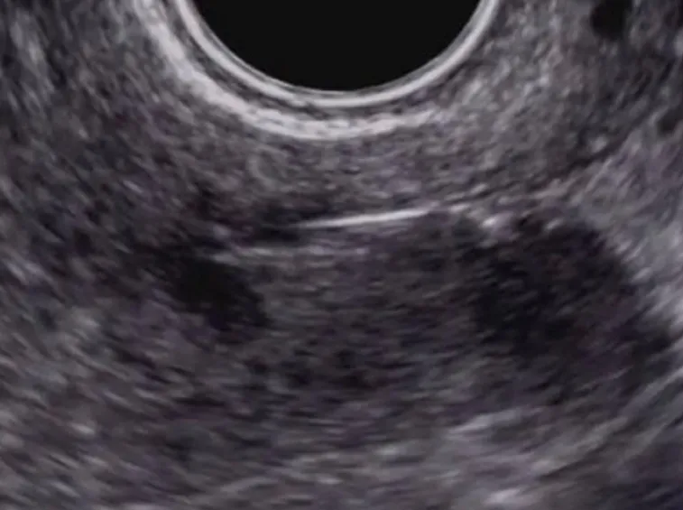 fibroma ovarico