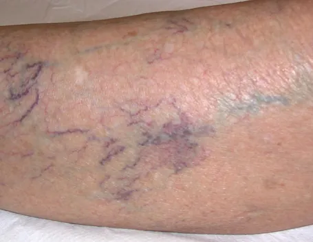 Flebite alla gamba