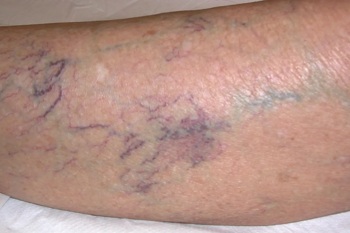 Flebite alla gamba