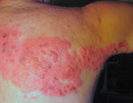 Manifestazione dell'Herpes Zoster