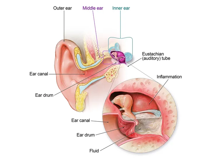 Infiammazione dell'orecchio interno