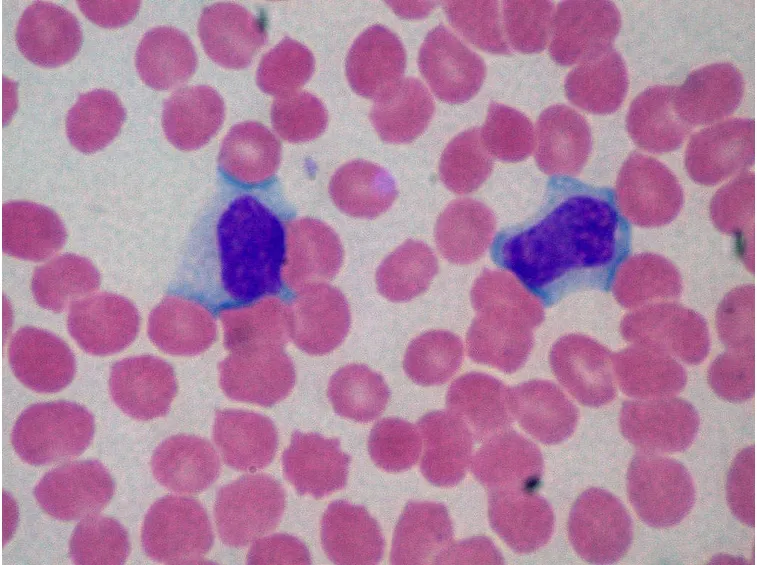 Striscio di sangue con linfociti B (in blu).
