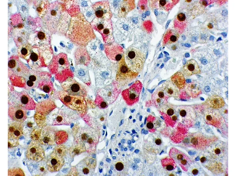 Epatite B microscopio
