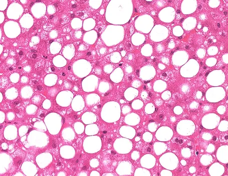 La steatosi è un'anomalia cellulare