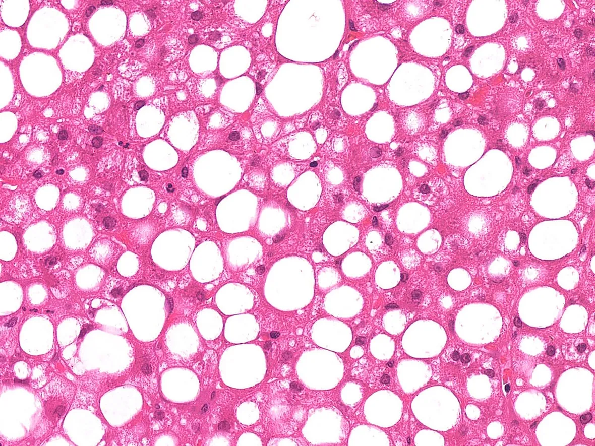La steatosi è un'anomalia cellulare
