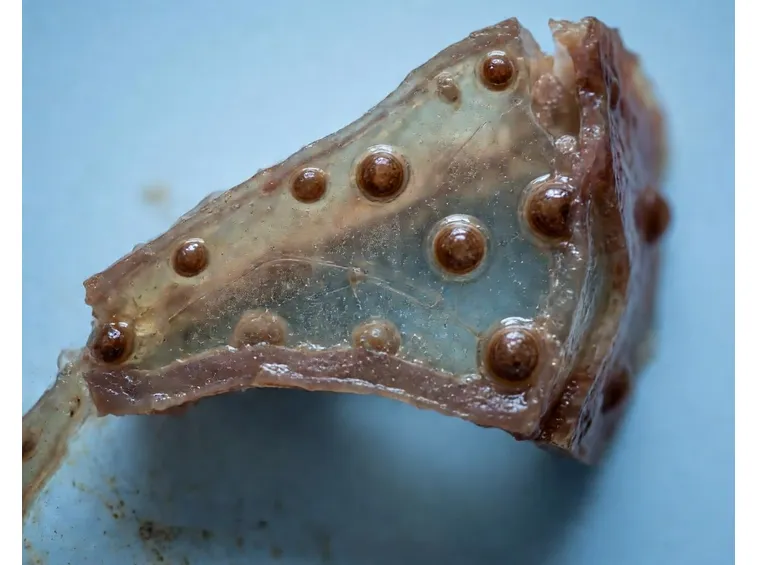 Radiografia di cisticercosi cerebrale