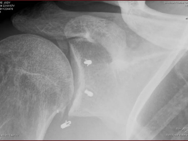 Radiografia articolazione spalla