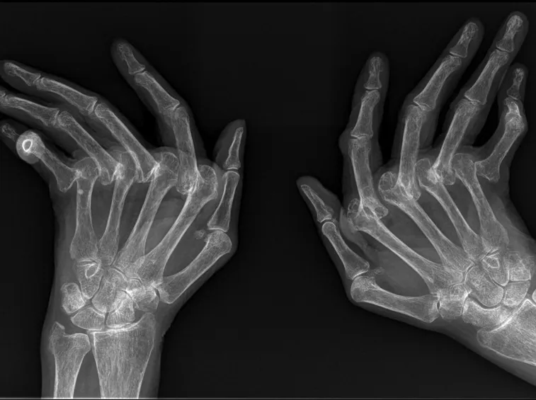 Radiografia di artrite reumatoide
