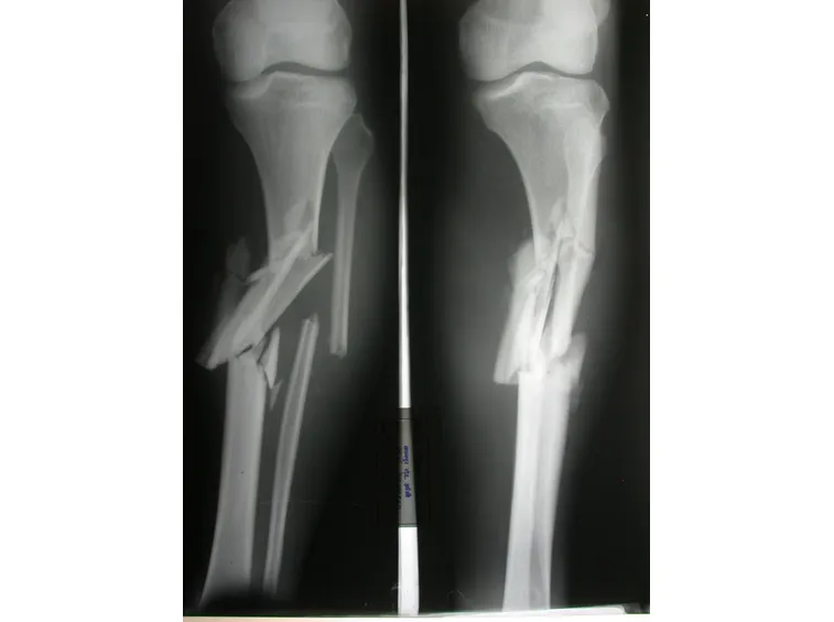 Frattura di tibia e perone
