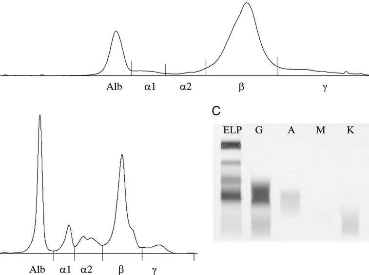 Grafico dell'elettroforesi proteica