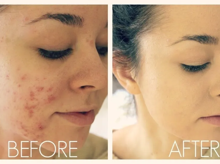 make up acne