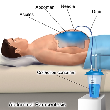 trattamento ascite