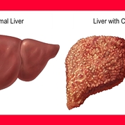 Fegato affetto da cirrosi epatica