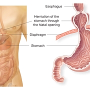 Raffigurazione di ernia iatale