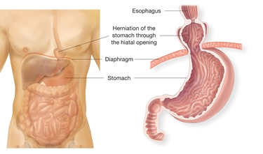 Raffigurazione di ernia iatale