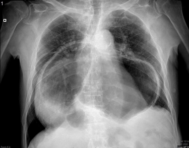 Radiografia di ernia iatale