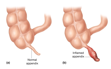Appendice normale e appendice infiammata a confronto