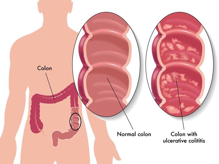 Rappresentazione del colon