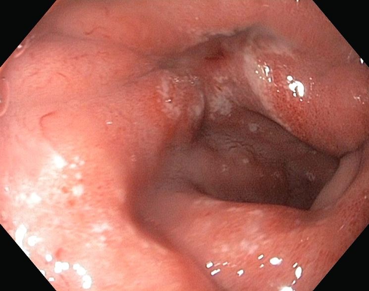 Ulcera peptica