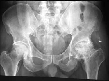 Radiografia di un'osteoartrite dell'anca
