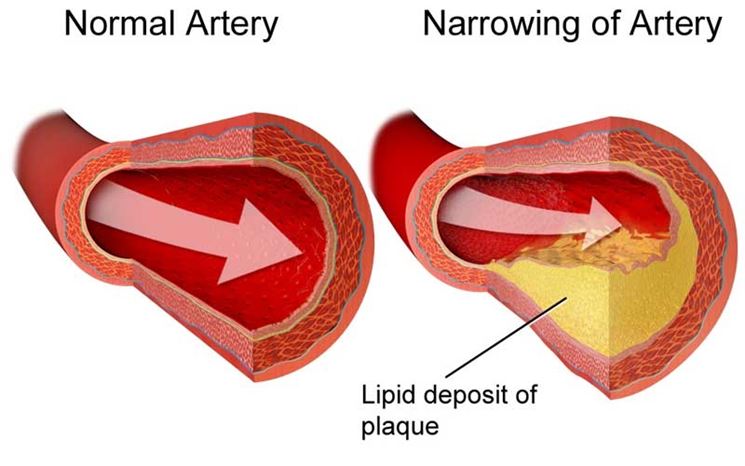 Arteria normale e arteria danneggiata da colesterolo