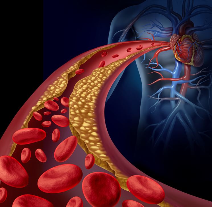 Ostruzione delle arterie per aterosclerosi