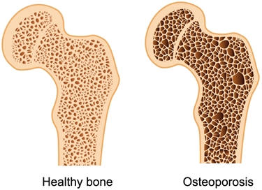 osteoporosi