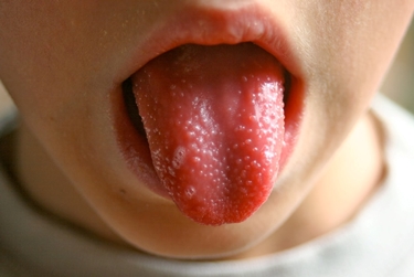 La lingua a fragola rossa<p />