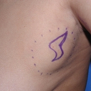 Lipoma ascellare