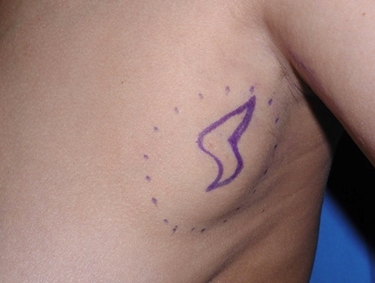 Lipoma ascellare