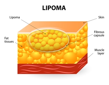 Struttura del lipoma