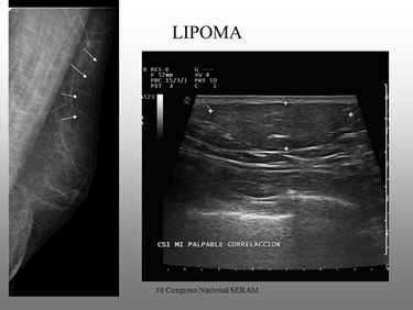 Ecografia di un lipoma