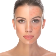 rosacea