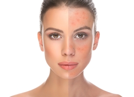 Acne rosacea