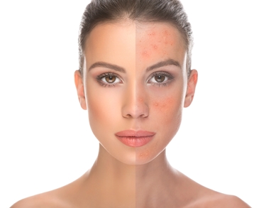 rosacea