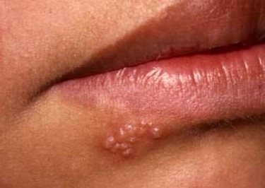 herpes simplex