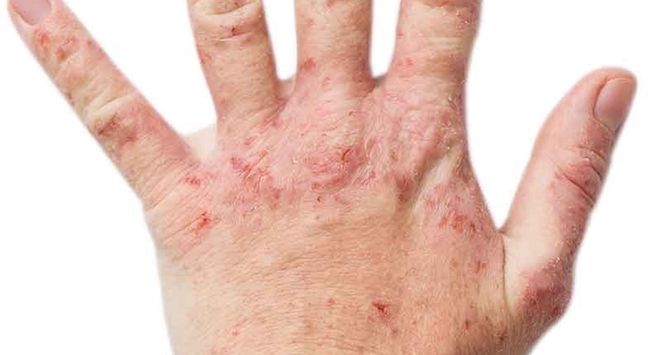 mani con eczema