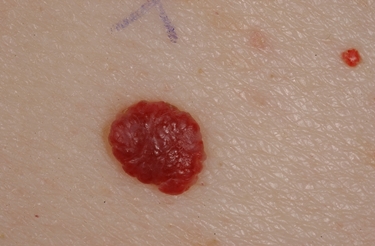 angioma