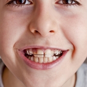 apparecchio ai denti bambini