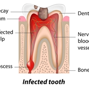 Dente cariato con ascesso