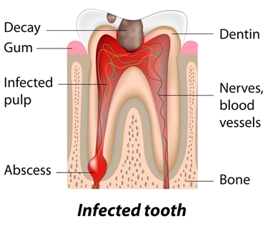 Dente cariato con ascesso